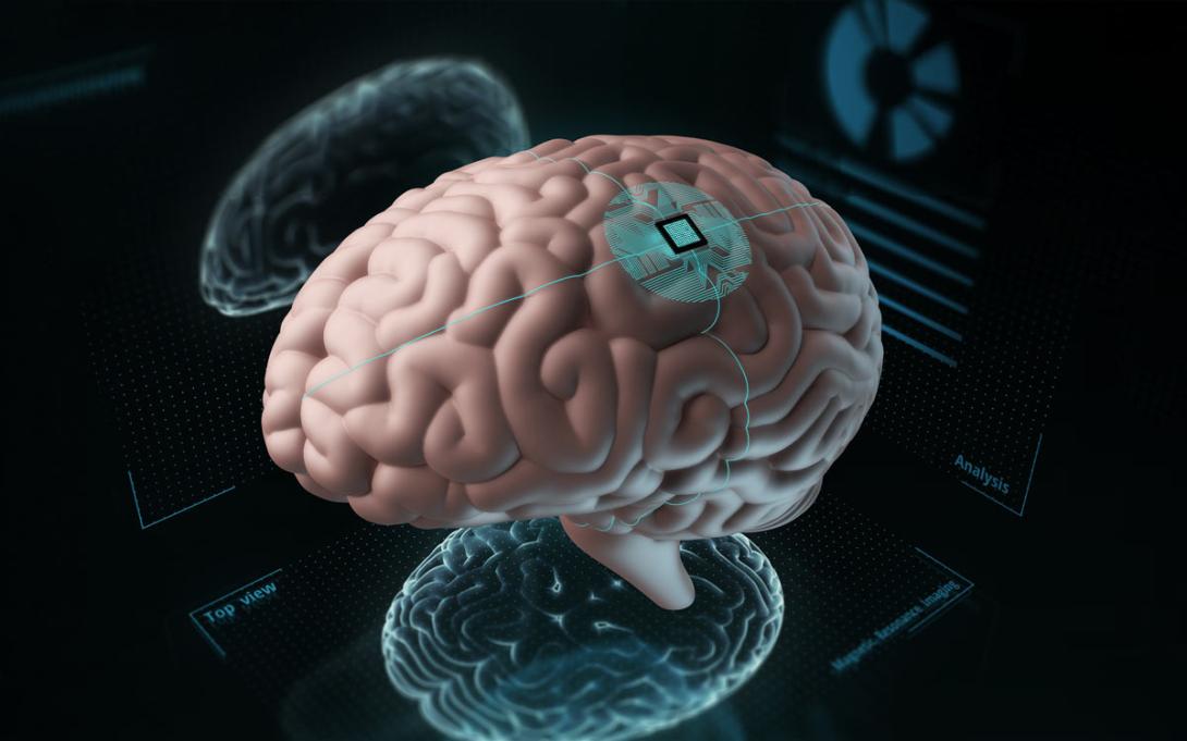 Aplican un implante cerebral que elimina pensamientos negativos-0